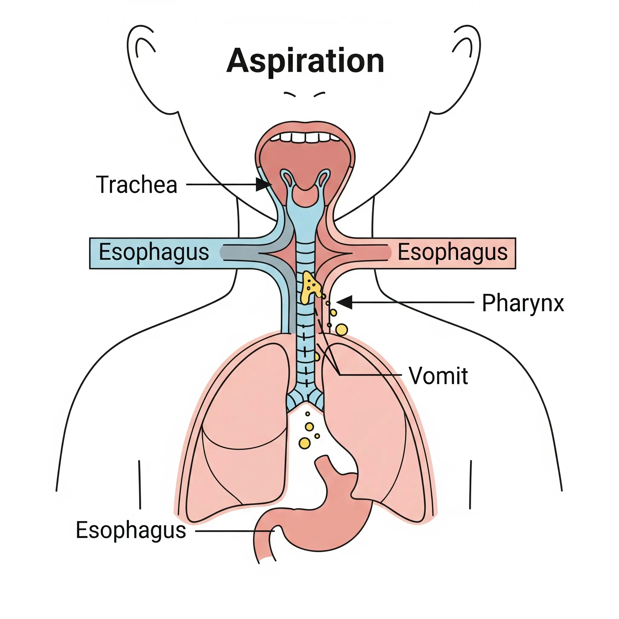 Medical diagram showing how vomit can enter the trachea (windpipe) instead of the esophagus.